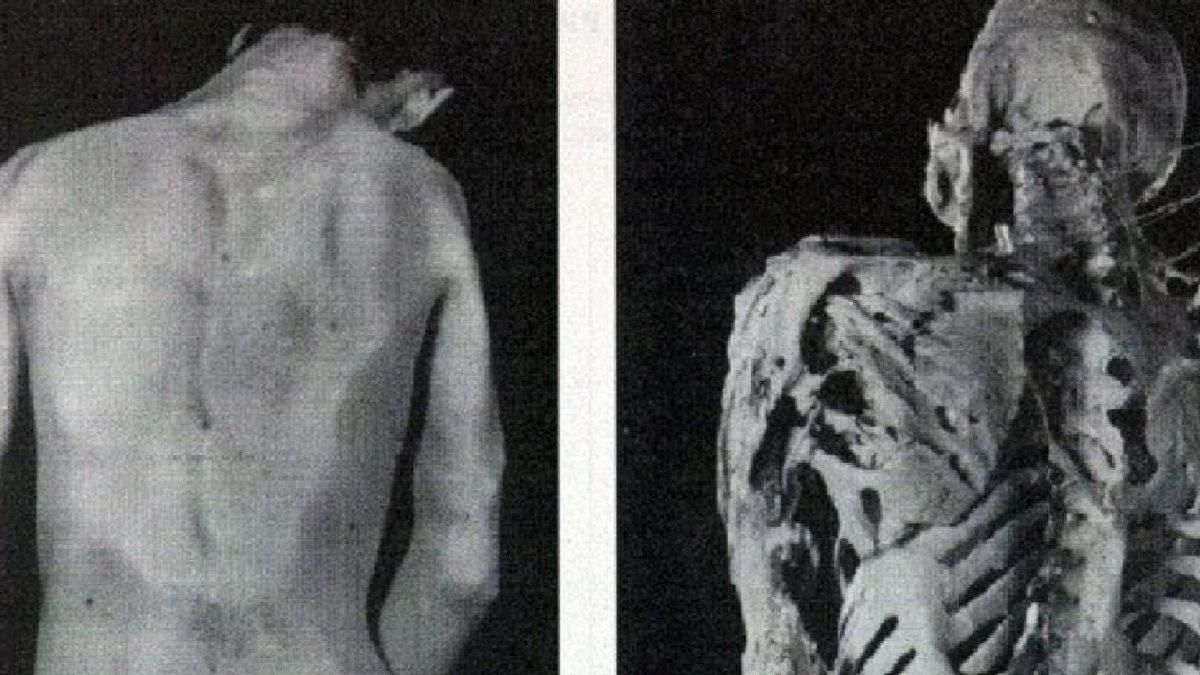 Dünyaya Bir Cüce Olarak Gelip Dev Olarak Yaşamını Yitiren Adam Rainer’ın Şaşkınlık Veren Hikayesi