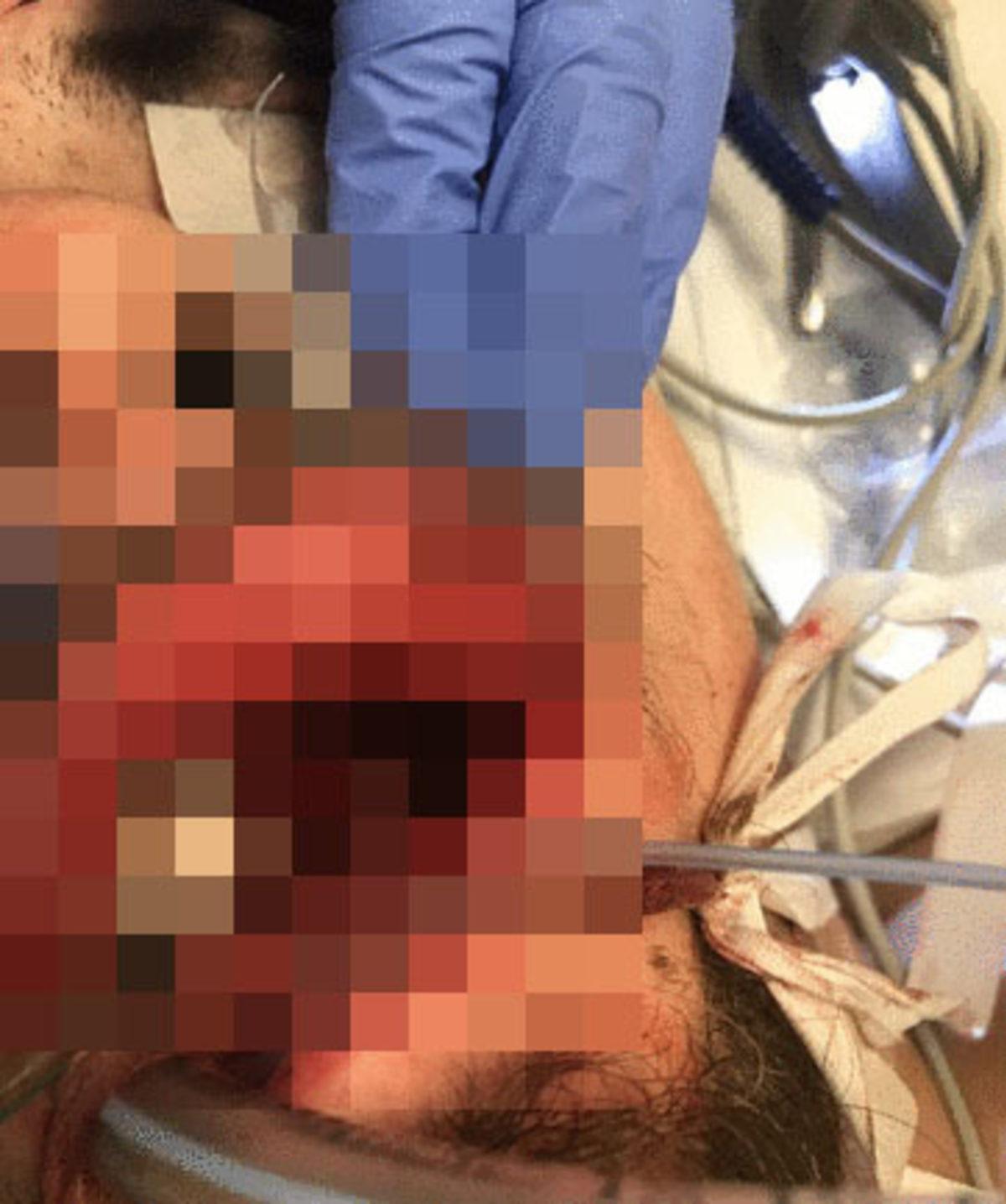 Elektronik Sigara, 19 Yaşındaki Gencin Yüzünde Patladı [Görüntü 18+]