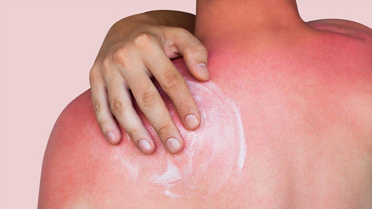 Yaz Aylarında Baş Belası Olabilen Güneş Yanıklarına Ne İyi Gelir?