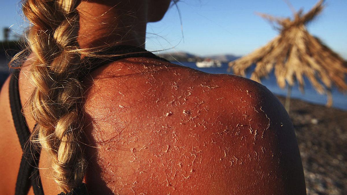 Yaz Aylarında Baş Belası Olabilen Güneş Yanıklarına Ne İyi Gelir?