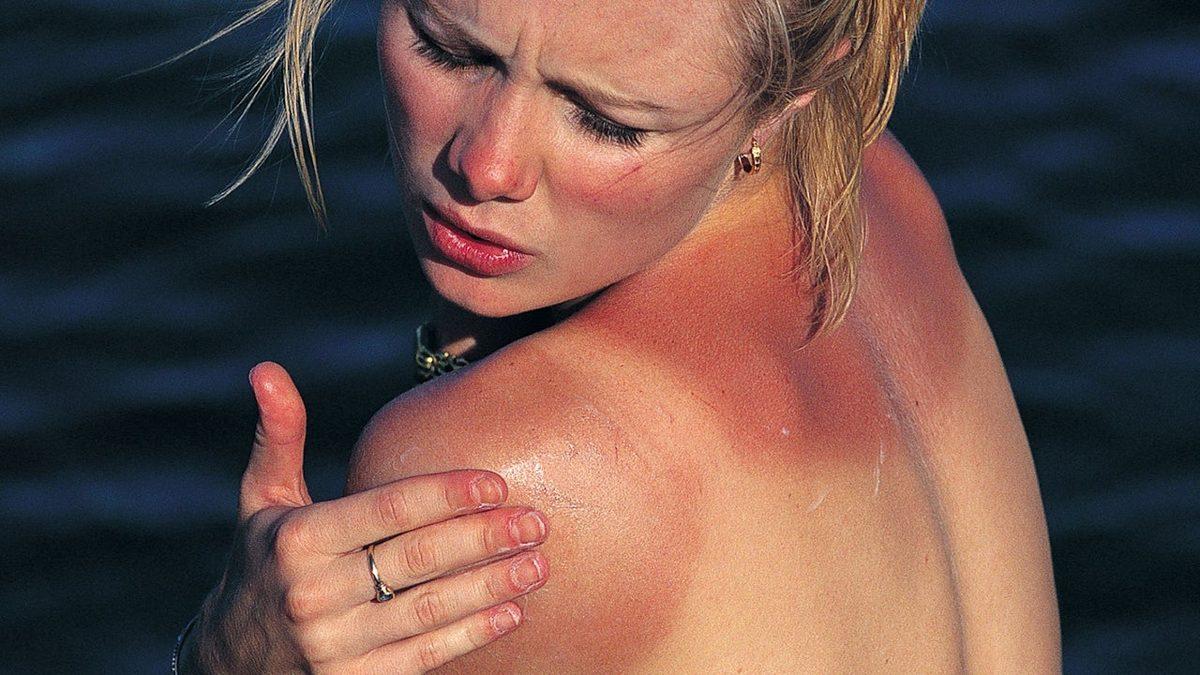 Yaz Aylarında Baş Belası Olabilen Güneş Yanıklarına Ne İyi Gelir?