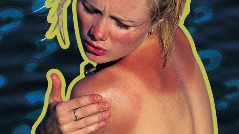 Yaz Aylarında Baş Belası Olabilen Güneş Yanıklarına Ne İyi Gelir?