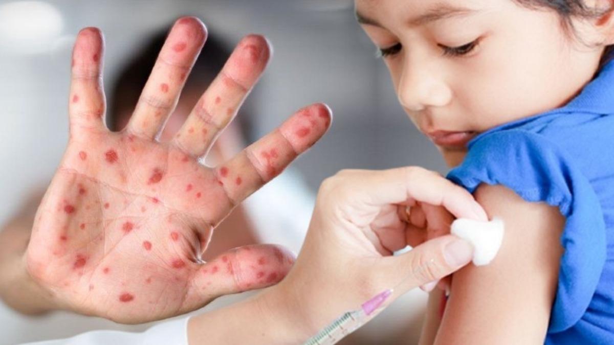 Kızamık Hastalığı, COVID-19 Sebebiyle Yükselişe Geçti: Milyonlarca Çocuğun Hayatını Tehdit Ediyor