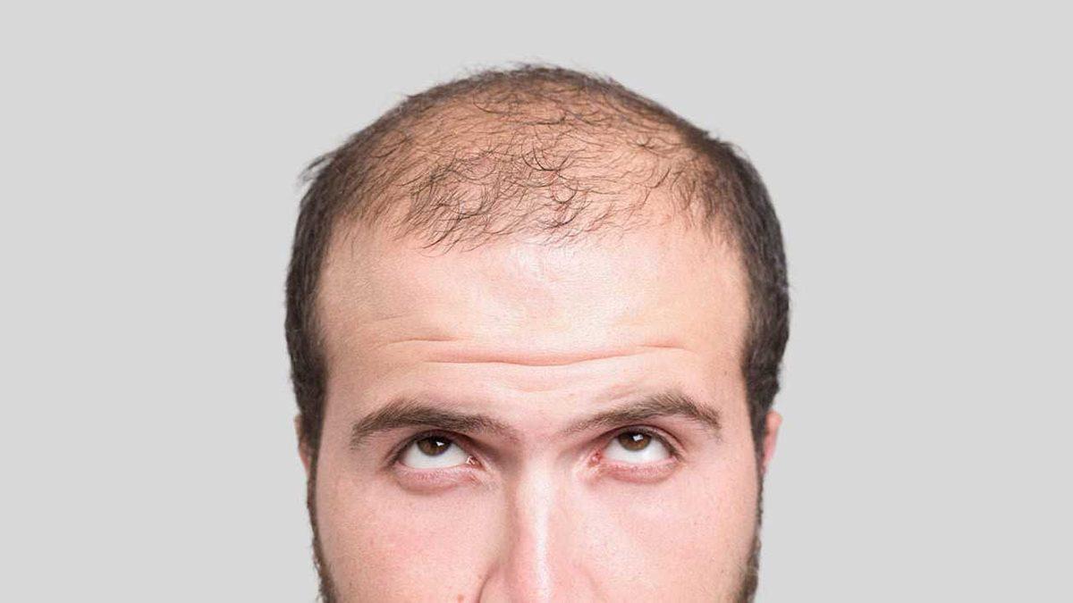 Japon Bilim İnsanları, Kelliğe Karşı Etkili Bir Çözüm Geliştirdi