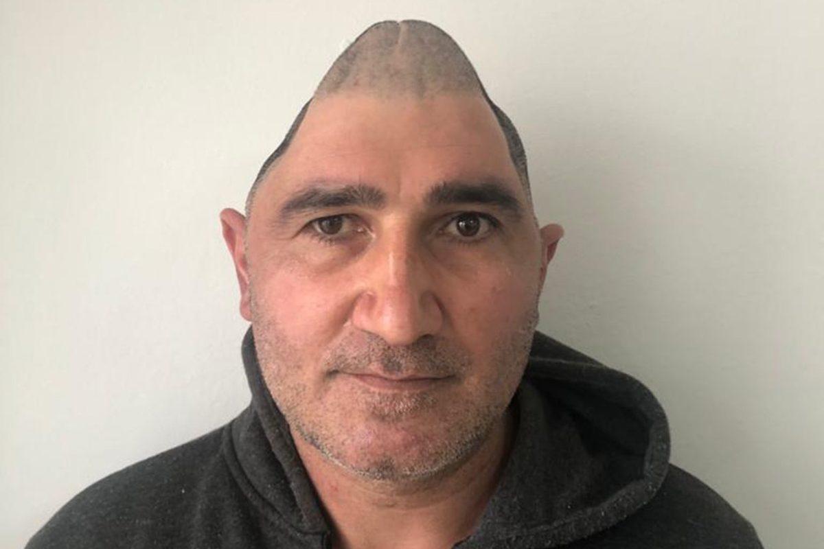 Kafatasının Yüzde 83’ü Parçalanan Adam, 3 Boyutlu Yazıcılarla Hazırlanan İmplantlar Sayesinde Eski Görüntüsüne Kavuştu