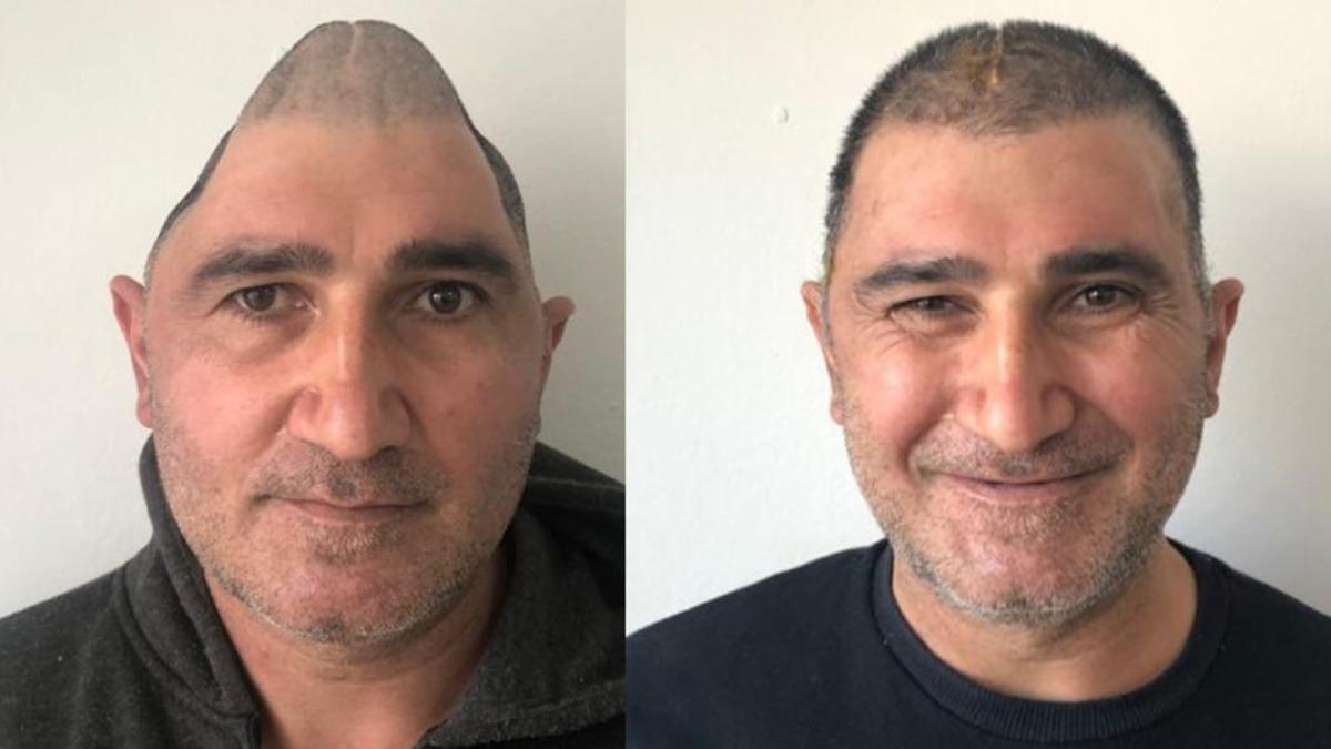 Kafatasının Yüzde 83’ü Parçalanan Adam, 3 Boyutlu Yazıcılarla Hazırlanan İmplantlar Sayesinde Eski Görüntüsüne Kavuştu