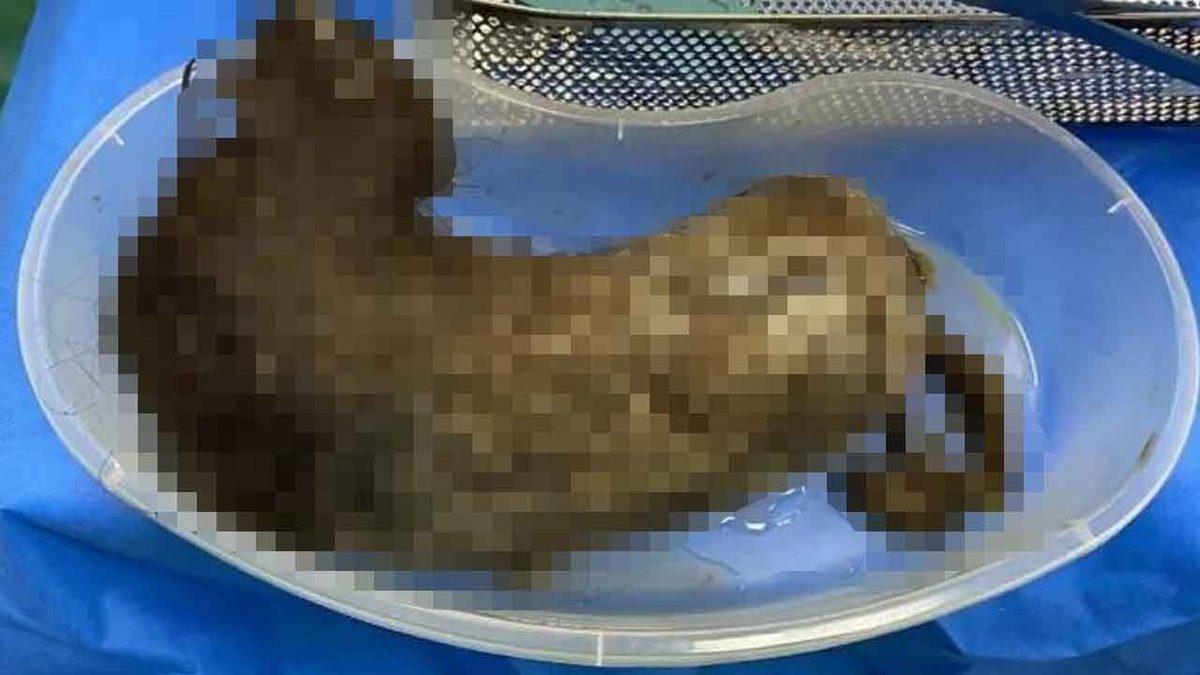 Saç Yeme Hastalığı Olan Bir Kızın Midesinden Devasa Boyutta Saç Yumağı Çıktı [18+ Görüntü]