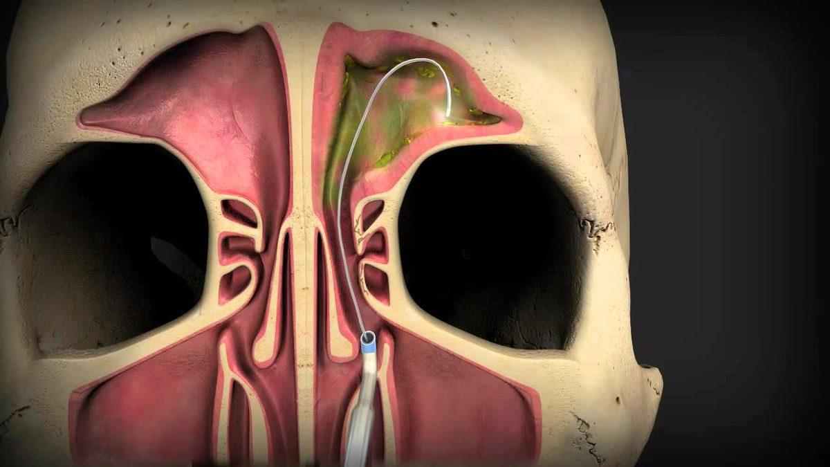 Sinüzit Nedir, Neden Olur, Sinüzite Ne İyi Gelir?