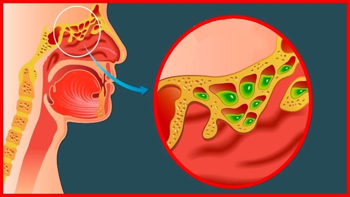 Sinüzit Nedir, Neden Olur, Sinüzite Ne İyi Gelir?