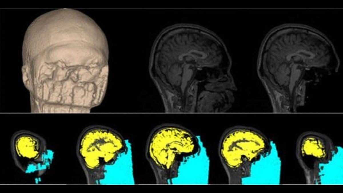Bilim İnsanları, Beyinde Korkuyu Yok Edip Cesareti Artırmanın Yolunu Buldu