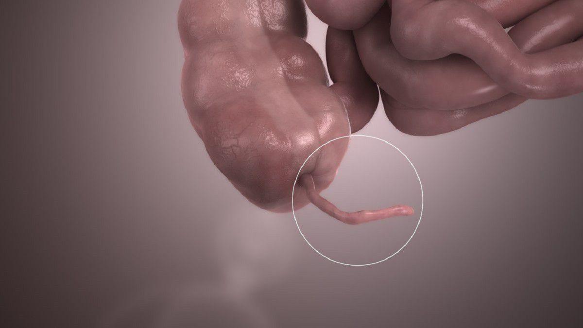 ’Apandisit’ Tam Olarak Nedir, Apandisit Rahatsızlığının Sebepleri ve Belirtileri Nelerdir?