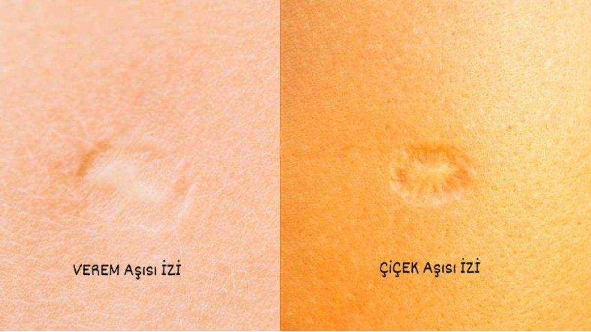Çiçek Aşısı Çoğu Aşının Aksine Kollarda Neden Büyük Bir İz Bırakıyordu?