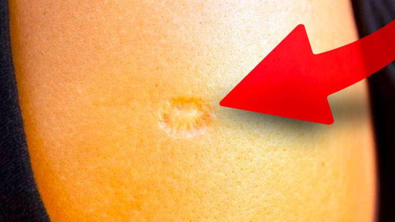 Çiçek Aşısı Çoğu Aşının Aksine Kollarda Neden Büyük Bir İz Bırakıyordu?