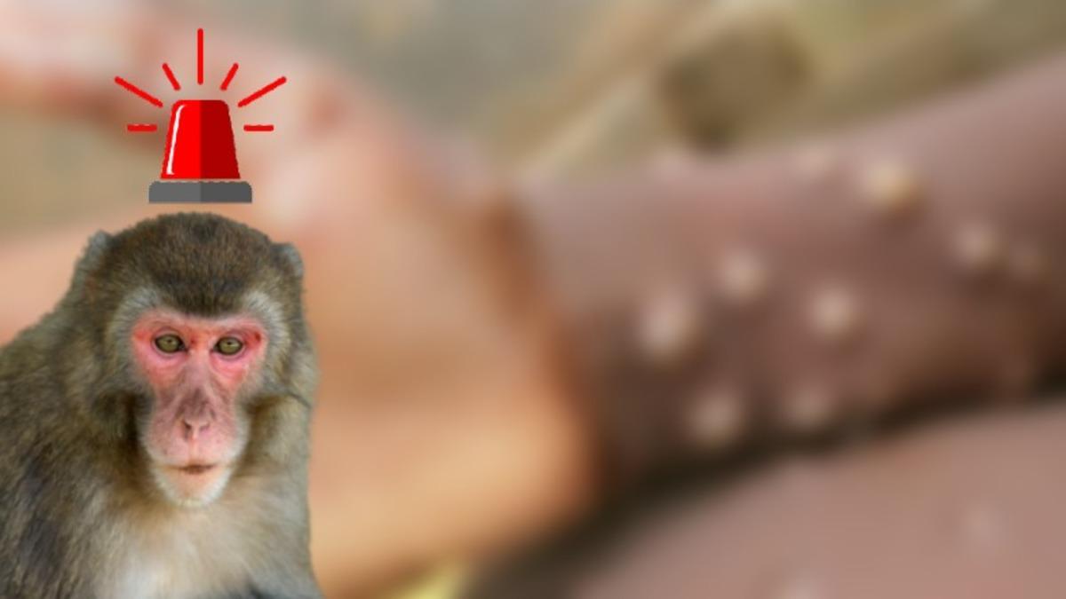 Dünya Sağlık Örgütü, Birçok Ülkede Görülen Maymun Çiçeği Virüsü İçin Acil Toplantı Yapacak