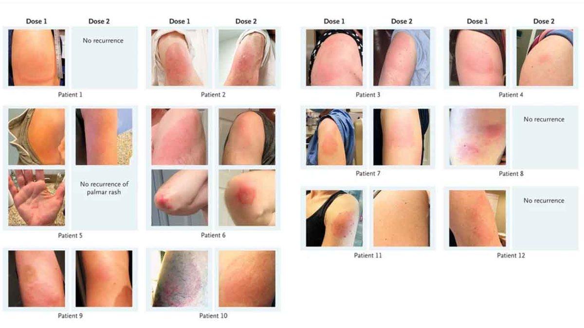 Moderna’nın Koronavirüs Aşısı, Ciltte 10 Santimetreyi Aşan Şişliklere Sebep Olabiliyor