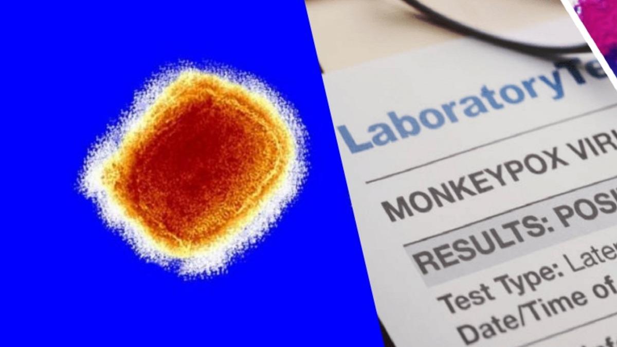 Maymun Çiçeği Virüsü Görülen Ülke Sayısı 21 Oldu: Toplam Vaka Sayısı 250’ye Yaklaştı!