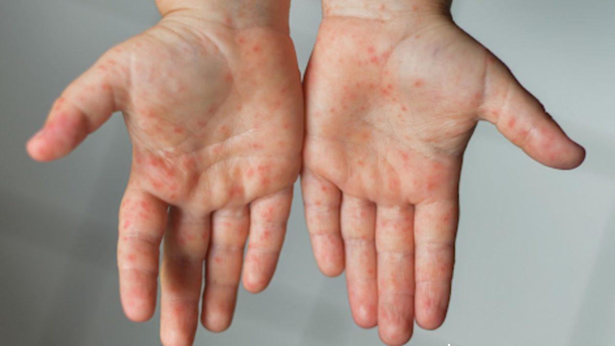 Milyonlarca İnsanın Hayatını Kurtararak Tarihin Seyrini Değiştiren Aşılar