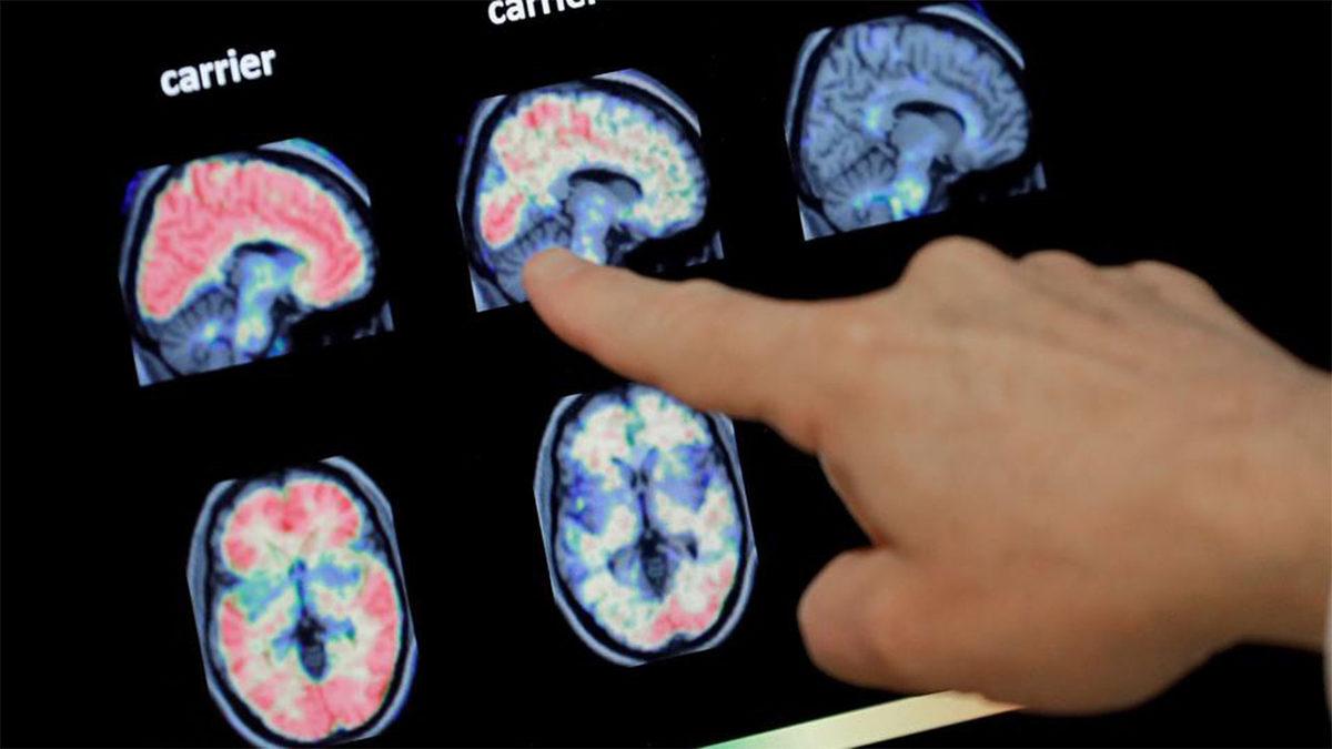 Bilim İnsanları, HIV İlacının Hafıza Kaybını Tersine Çevirdiğini Keşfetti: Alzheimer’a Çözüm Olabilir