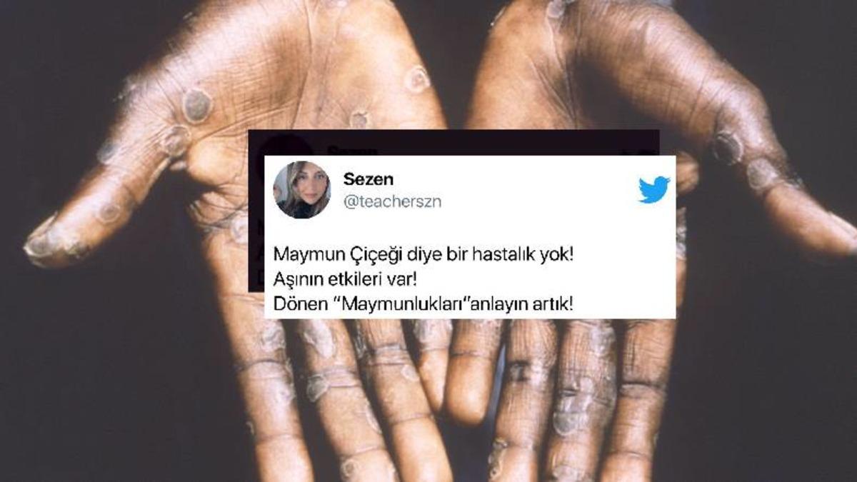 Maymun Çiçeği Virüsü Hakkında Karşımıza Çıkan Akıllara Zarar 6 Komplo Teorisi: Küreselciler Yine İş Başında(!)