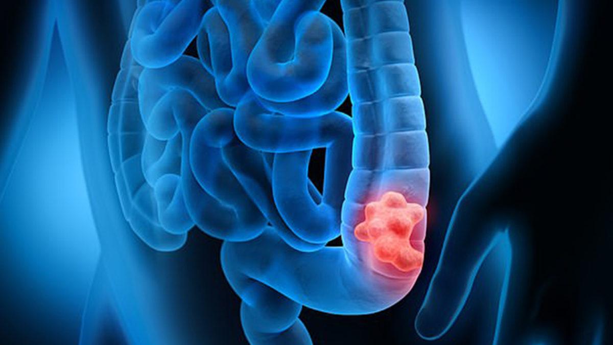 Tıpta Yeni Devrim: ABD’de Deneysel Bir İlacın Kansere Çare Olabileceği Keşfedildi