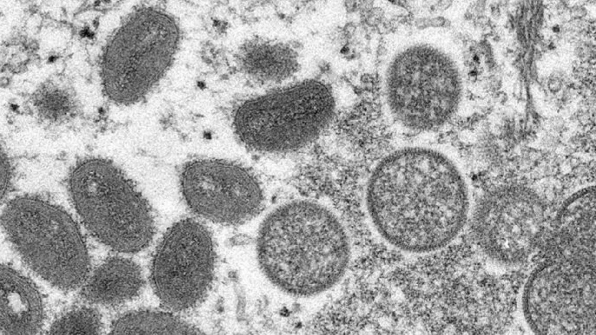 Maymun Çiçeği Virüsü Artık Çok Yakınımızda: Yunanistan’da İlk Vaka Tespit Edildi