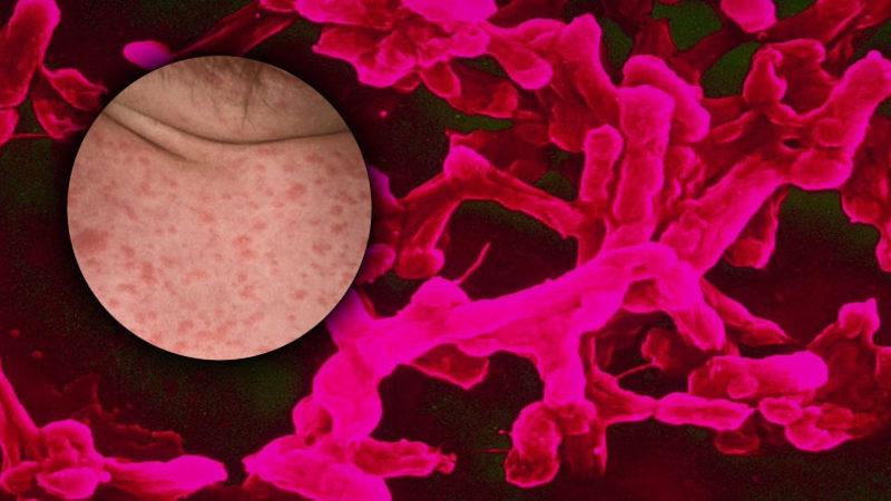 İlaçlara Bağışıklık Kazandı: Bilim İnsanlarına Göre Tifo, Yakında Büyük Bir Salgına Dönüşebilir