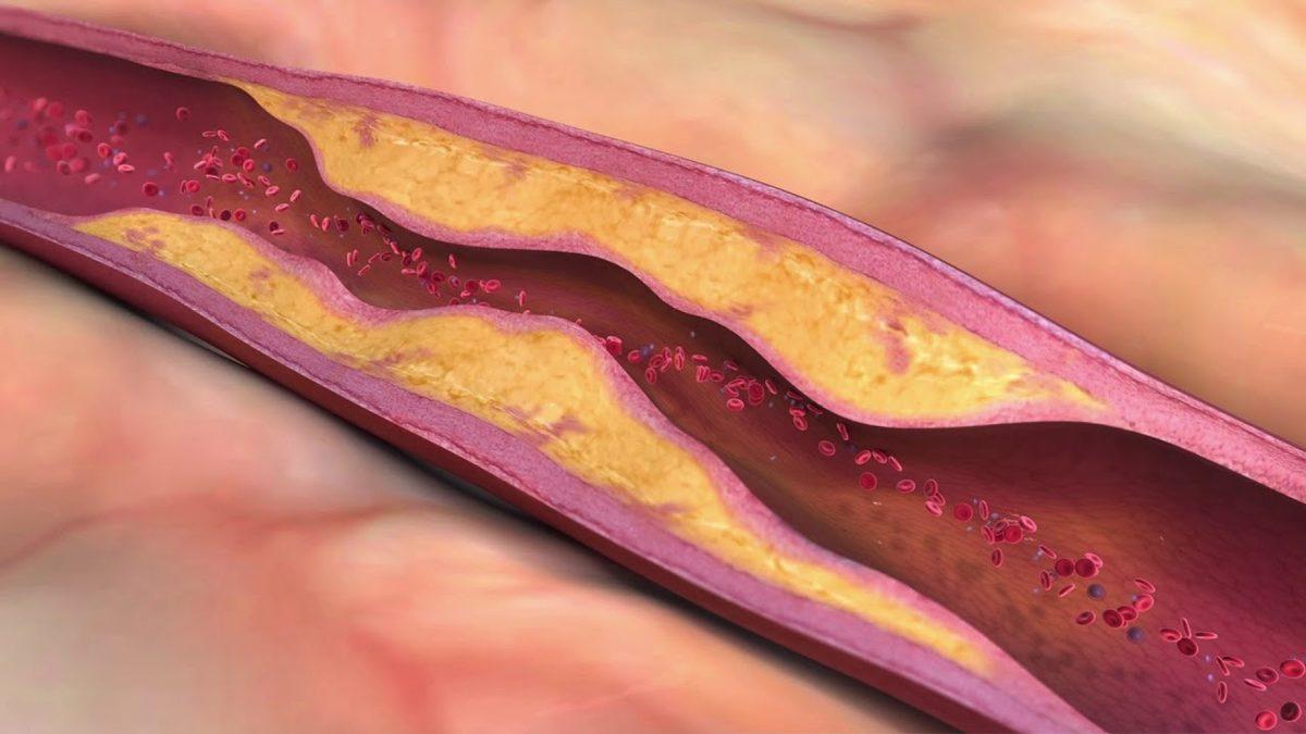 Vücudumuzun Enerji Deposu Olan ‘Trigliserit’ Aslında Nedir?