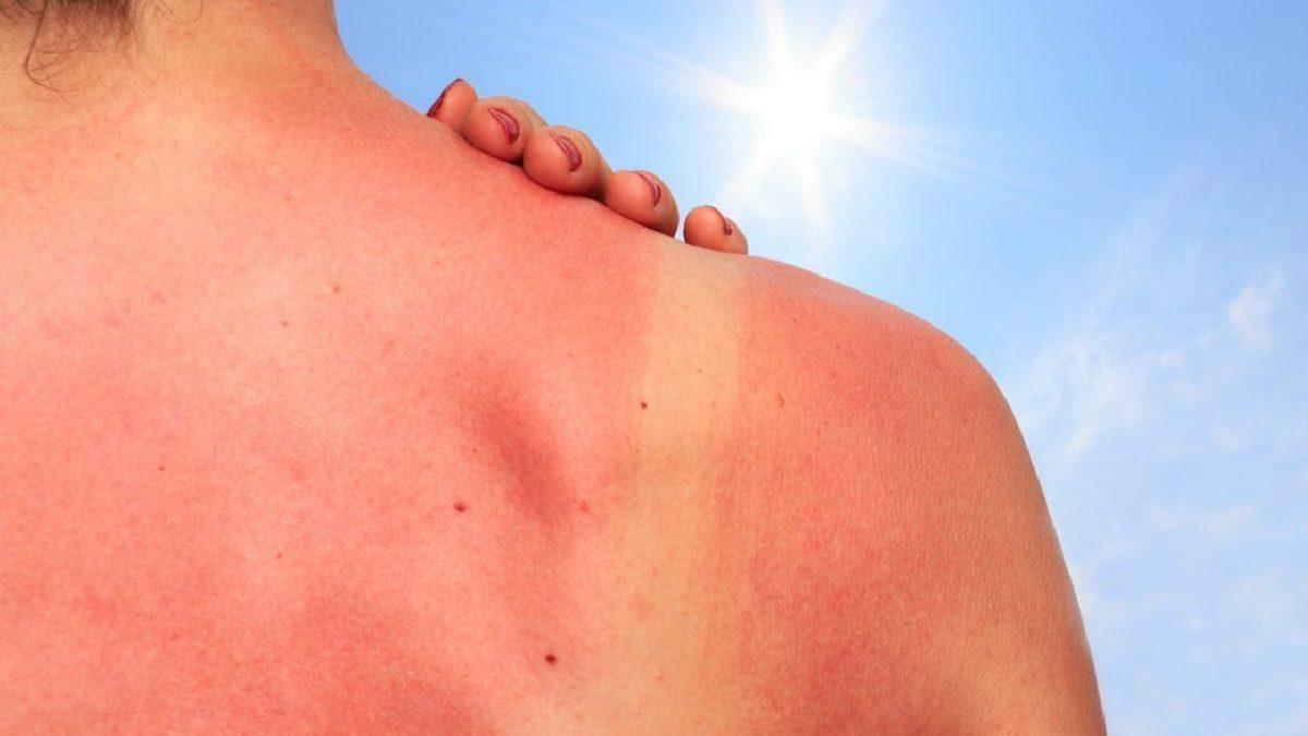 Güneş Kremi Kullanmazsanız Derinizin Ne Hale Gelebileceğini Gösteren Çarpıcı Sonuçlar! Peki Alırken Nelere Dikkat Etmeniz Gerekiyor?