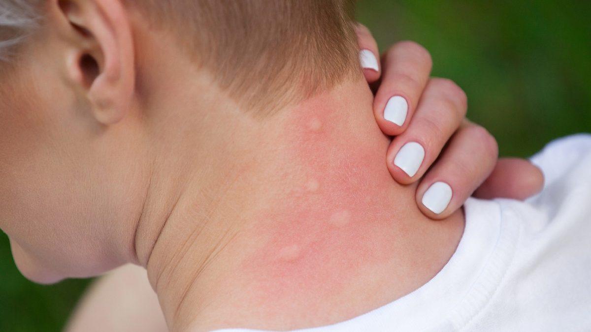 Sivrisinekler Bazı İnsanları Neden Daha Fazla Isırır? Bilimsel Sebeplerini Açıkladık