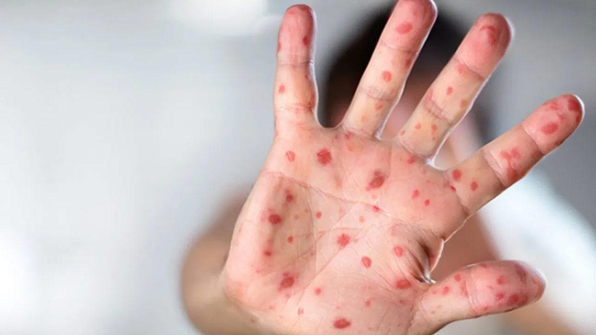 DSÖ’den Kritik Maymun Çiçeği Virüsü Toplantısı: Küresel Acil Durum İlan Edilebilir