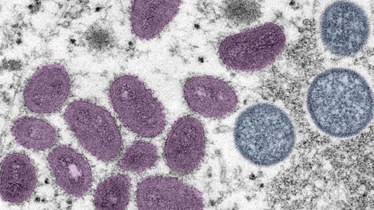 Maymun Çiçeği Virüsünün Çok Büyük Bir Hızla Mutasyona Uğradığı Keşfedildi