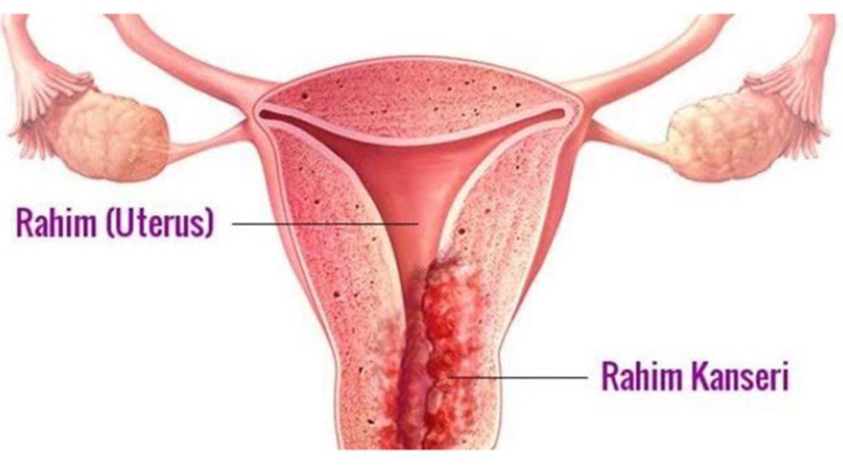 Cinsel Yolla Bulaşan ve Hem Kadınlar Hem Erkekler İçin Tehlike Arz Eden HPV Hakkında Bilmeniz Gerekenler