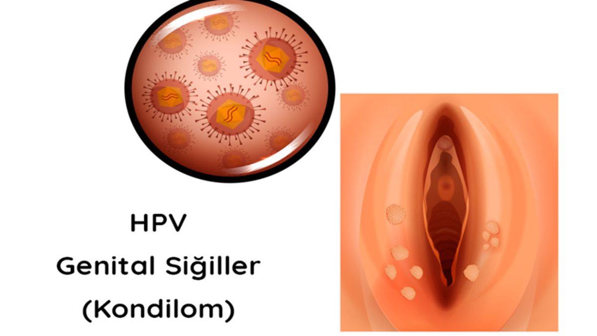 Cinsel Yolla Bulaşan ve Hem Kadınlar Hem Erkekler İçin Tehlike Arz Eden HPV Hakkında Bilmeniz Gerekenler
