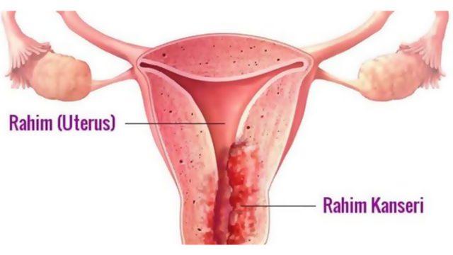Cinsel Yolla Bulaşan ve Hem Kadınlar Hem Erkekler İçin Tehlike Arz Eden HPV Hakkında Bilmeniz Gerekenler