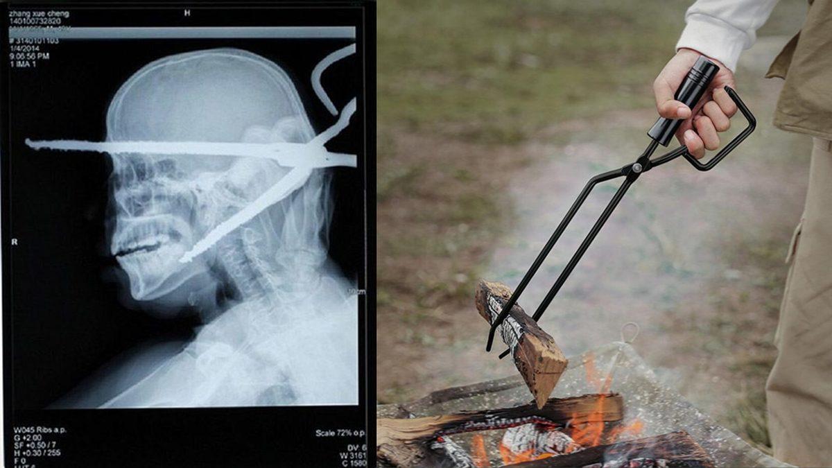 Hassas Bünyelerde Kalp Çarpıntısına Neden Olabilecek 22 X-ray Görüntüsü