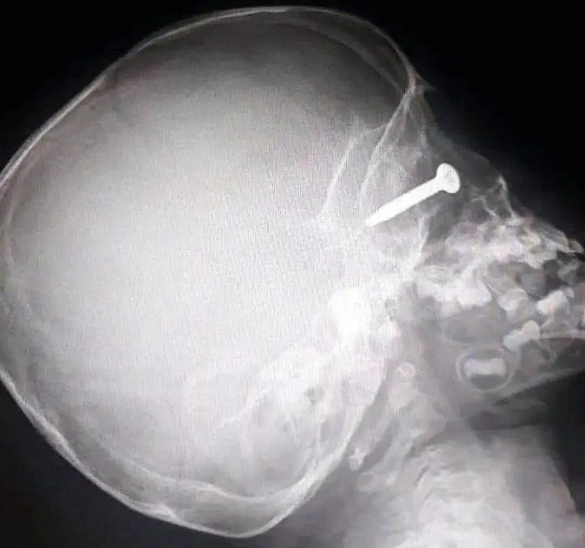 Hassas Bünyelerde Kalp Çarpıntısına Neden Olabilecek 22 X-ray Görüntüsü