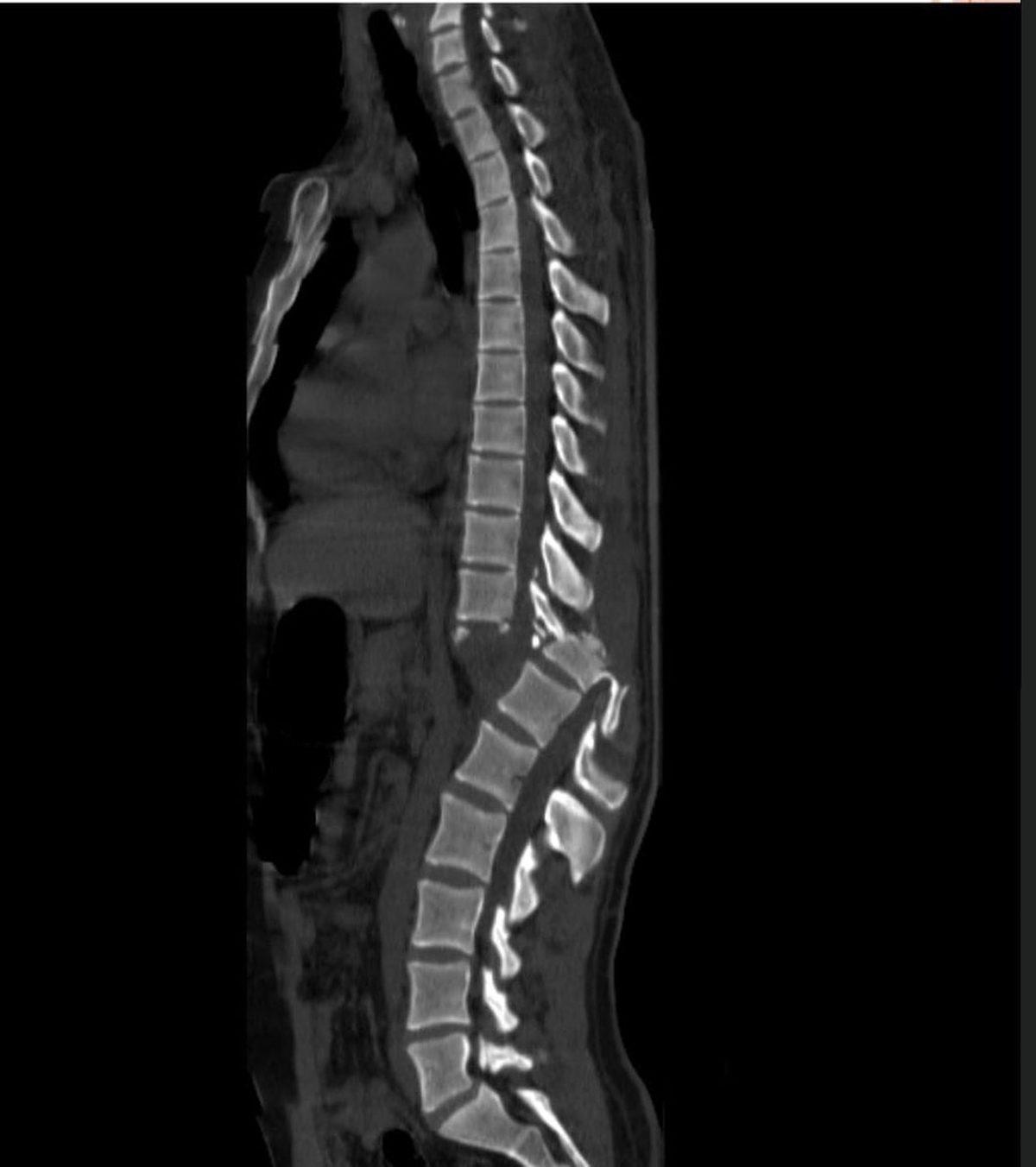 Hassas Bünyelerde Kalp Çarpıntısına Neden Olabilecek 22 X-ray Görüntüsü