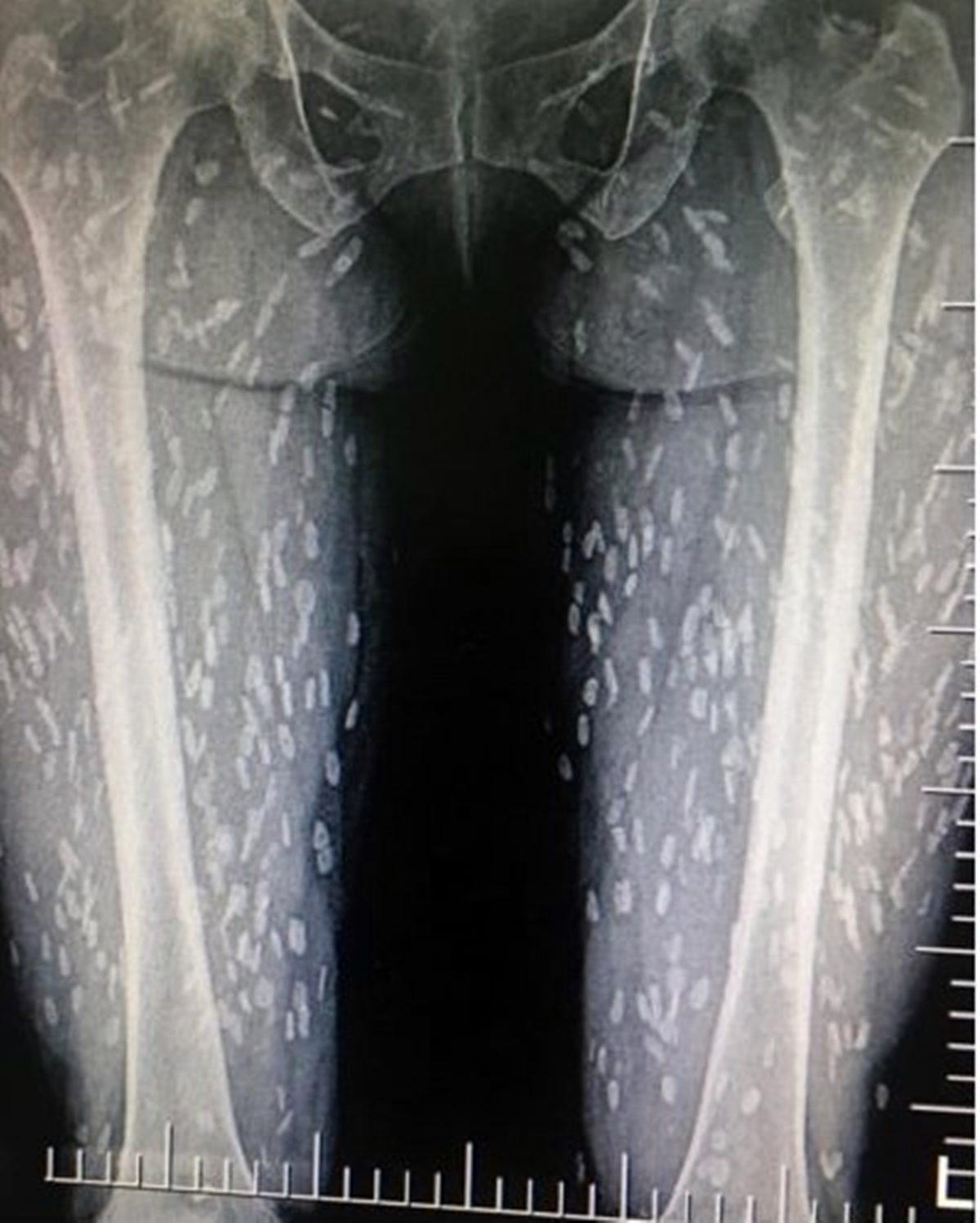 Hassas Bünyelerde Kalp Çarpıntısına Neden Olabilecek 22 X-ray Görüntüsü