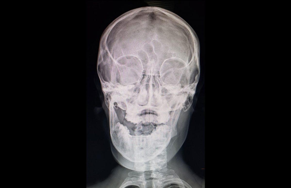 Hassas Bünyelerde Kalp Çarpıntısına Neden Olabilecek 22 X-ray Görüntüsü