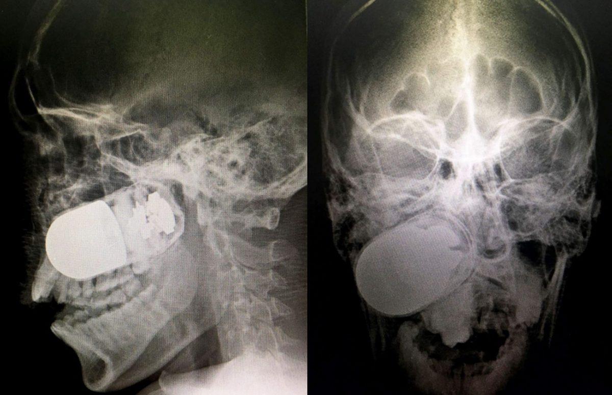 Hassas Bünyelerde Kalp Çarpıntısına Neden Olabilecek 22 X-ray Görüntüsü