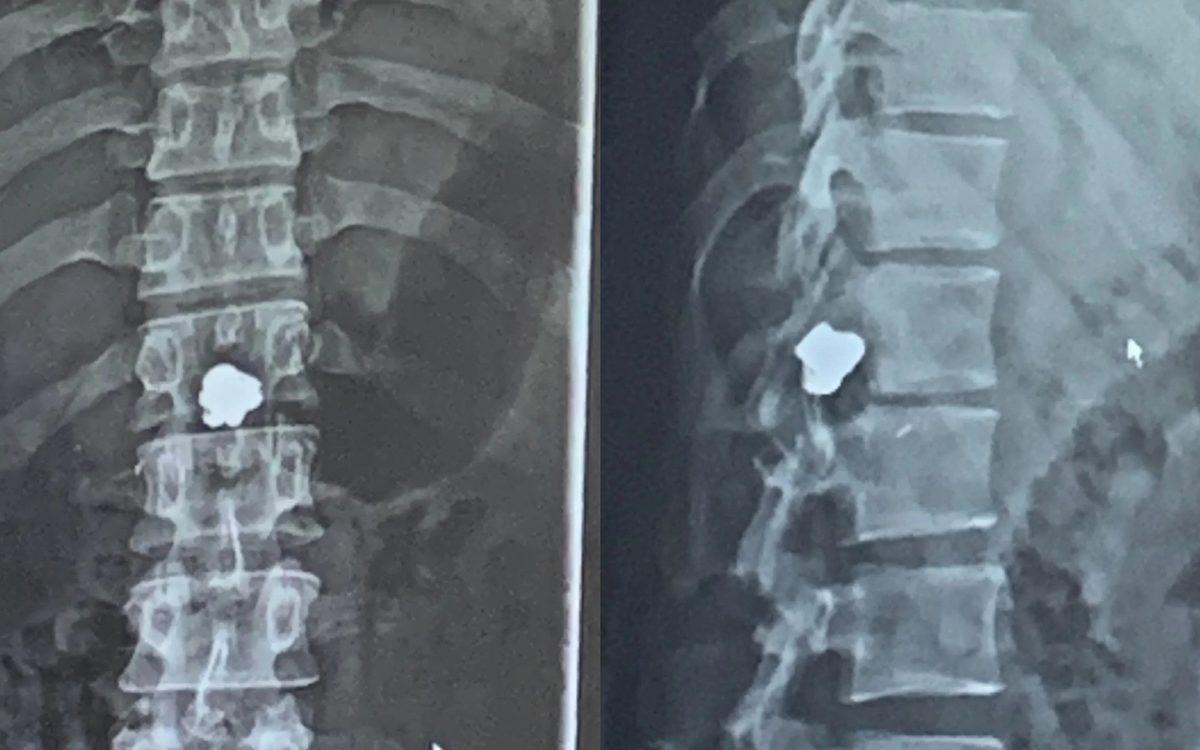 Hassas Bünyelerde Kalp Çarpıntısına Neden Olabilecek 22 X-ray Görüntüsü
