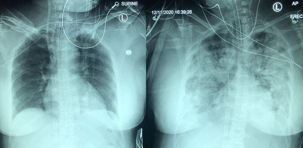 Hassas Bünyelerde Kalp Çarpıntısına Neden Olabilecek 22 X-ray Görüntüsü