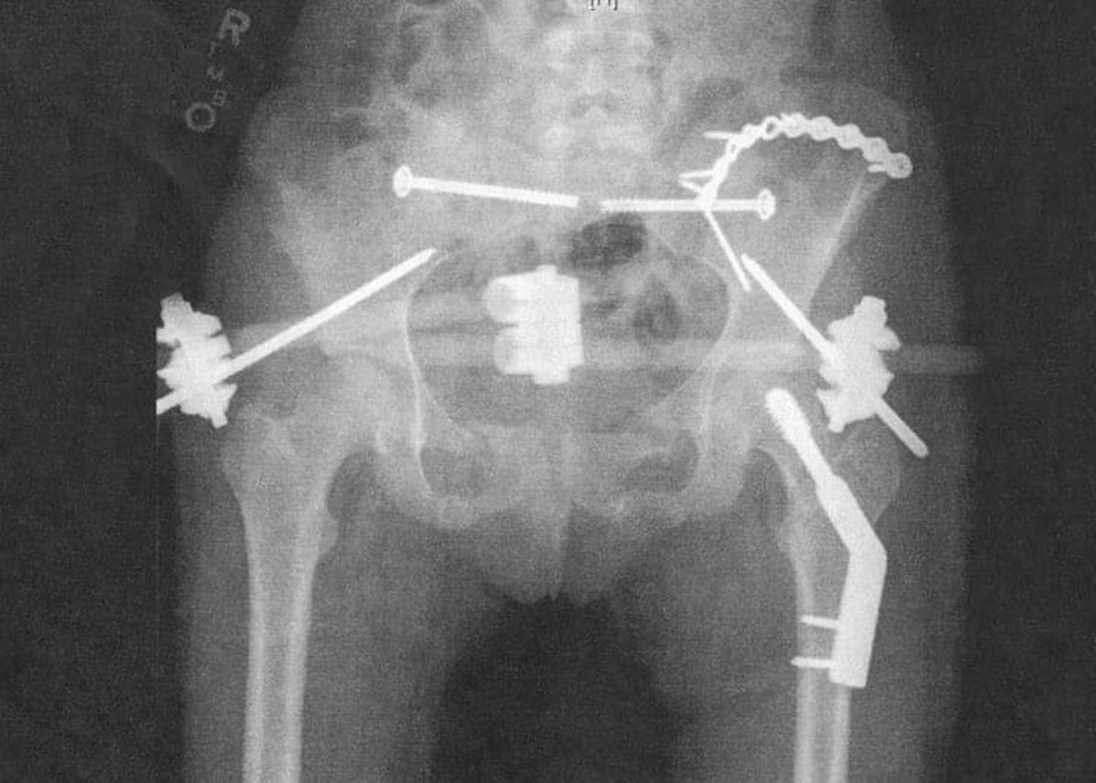 Hassas Bünyelerde Kalp Çarpıntısına Neden Olabilecek 22 X-ray Görüntüsü