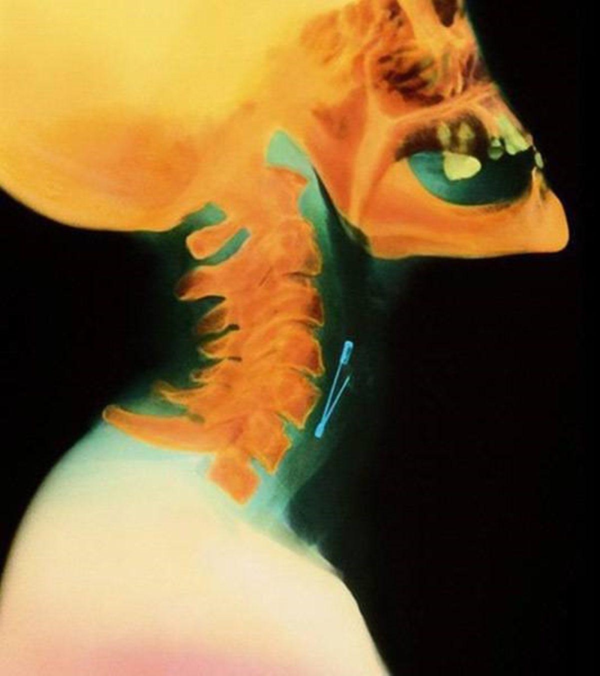 Hassas Bünyelerde Kalp Çarpıntısına Neden Olabilecek 22 X-ray Görüntüsü