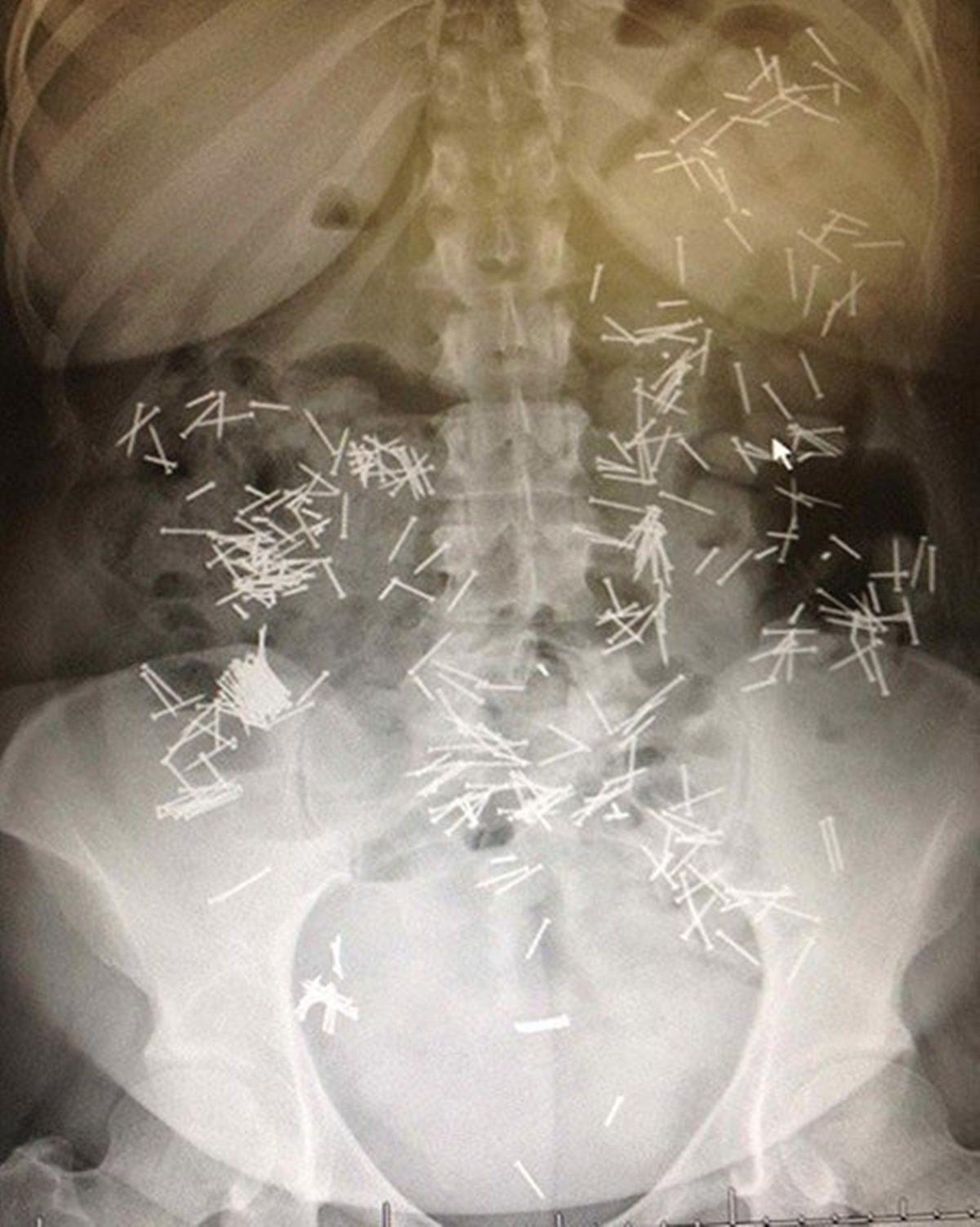 Hassas Bünyelerde Kalp Çarpıntısına Neden Olabilecek 22 X-ray Görüntüsü