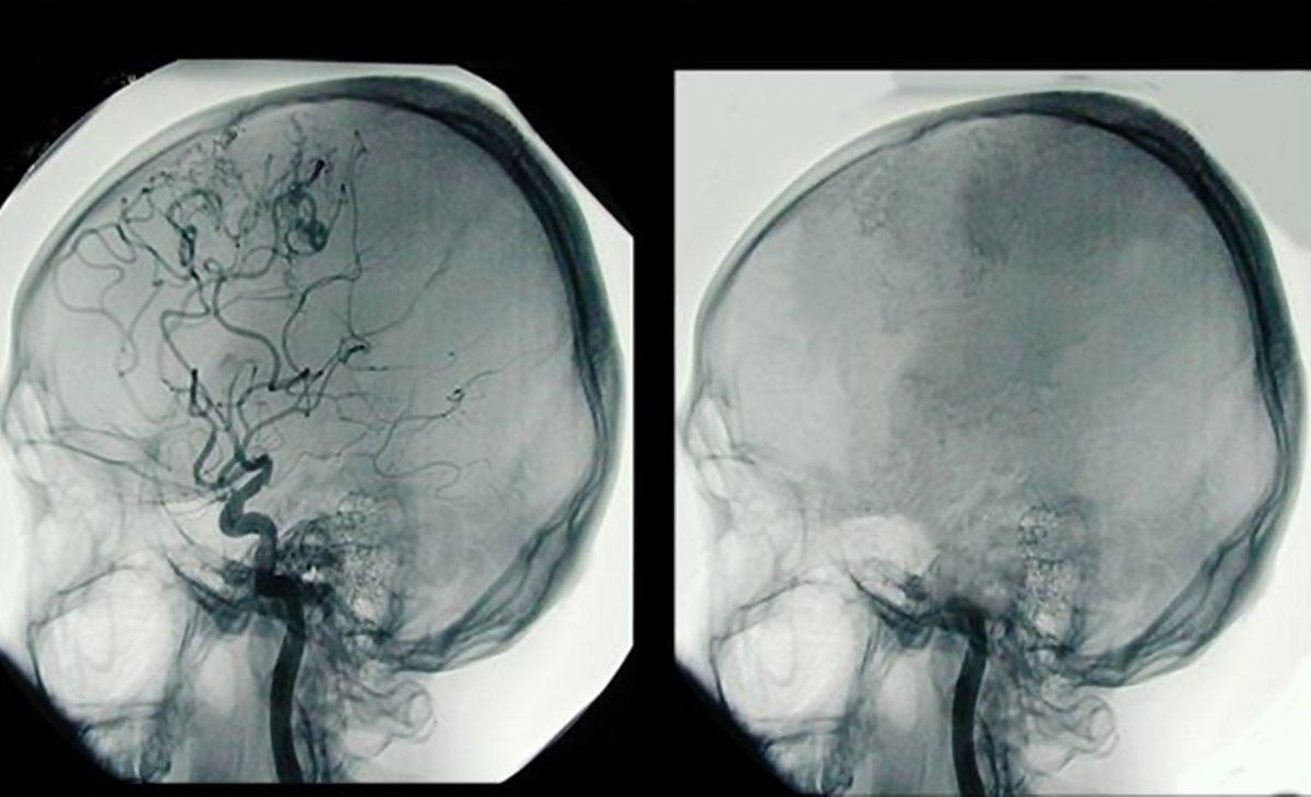Hassas Bünyelerde Kalp Çarpıntısına Neden Olabilecek 22 X-ray Görüntüsü