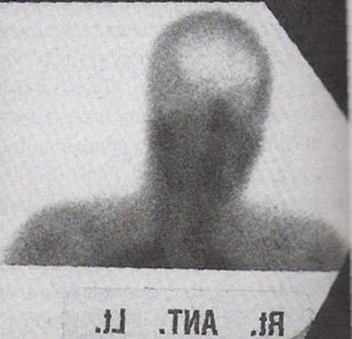 Hassas Bünyelerde Kalp Çarpıntısına Neden Olabilecek 22 X-ray Görüntüsü