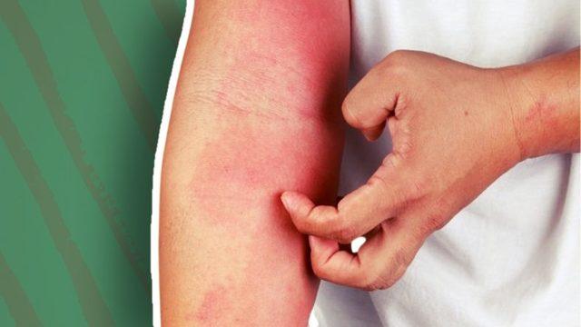 Hassas Ciltlilerin Baş Belası Güneş Alerjisini Engellemek için Bilmeniz Gerekenler