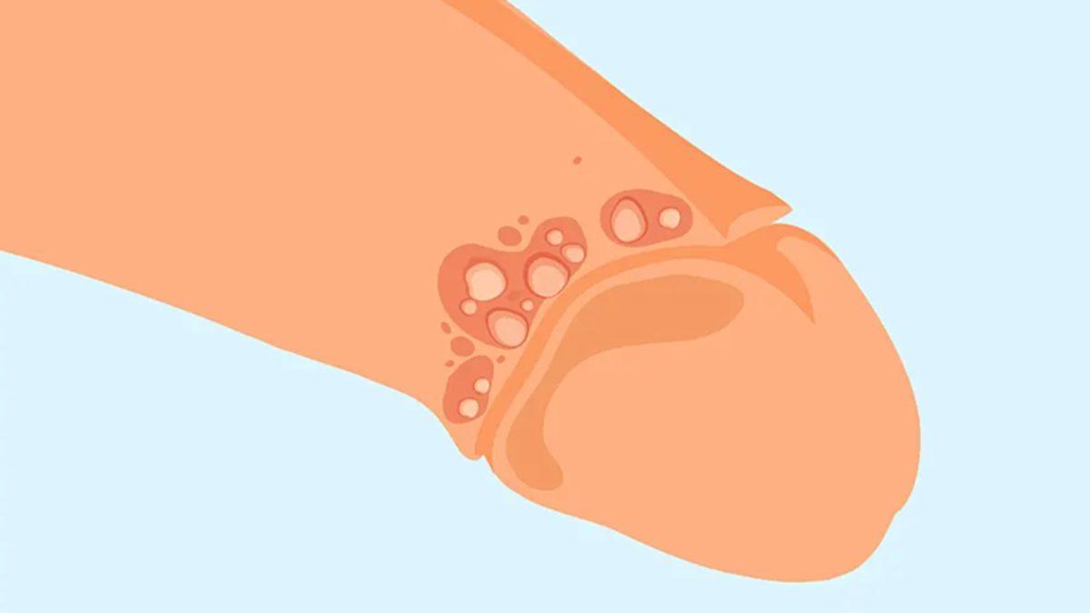 Cinsellikle Bulaşan ve Hayatınızı En Az HPV Kadar Olumsuz Etkileyen ’HSV Virüsü’ Hakkında Bilmeniz Gerekenler