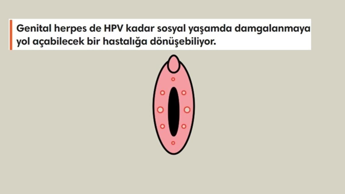 Cinsellikle Bulaşan ve Hayatınızı En Az HPV Kadar Olumsuz Etkileyen ’HSV Virüsü’ Hakkında Bilmeniz Gerekenler